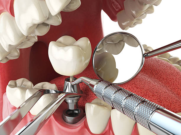 Best Emergency Root Canal Treatment in East Northport, NY